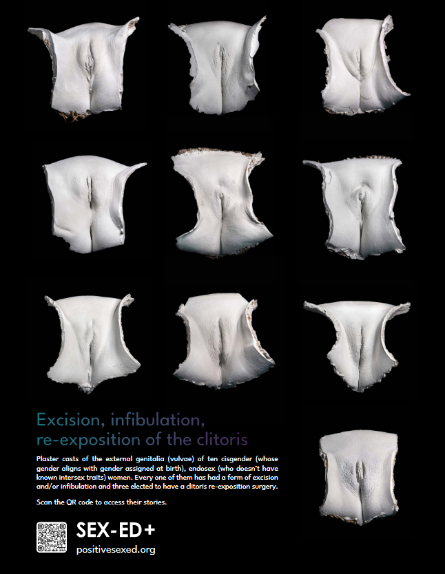 Poster excision, infibulation, re-exposition of the clitoris- 10 models - 24/18 inches - 61/46cm