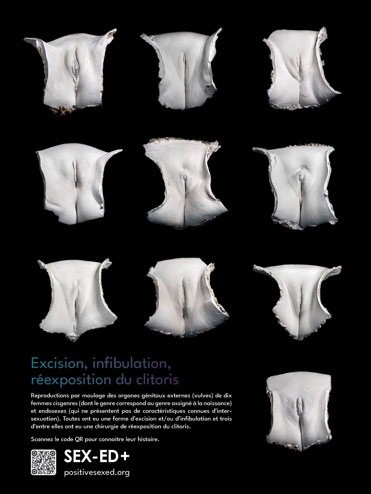 Poster excision, infibulation, re-exposition du clitoris. 10 Modèles (61/45cm - 24/18 pouces)